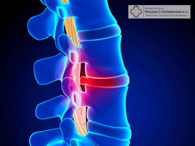 Herniated Disc Injury Lawyer